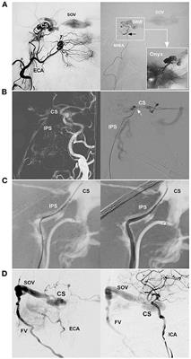 Transfemoral trans-facial vein-superior ophthalmic vein to embolize cavernous sinus dural arteriovenous fistulas